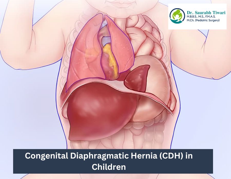 Congenital Diaphragmatic Hernia (CDH) in Children | Dr. Saurabh Tiwari