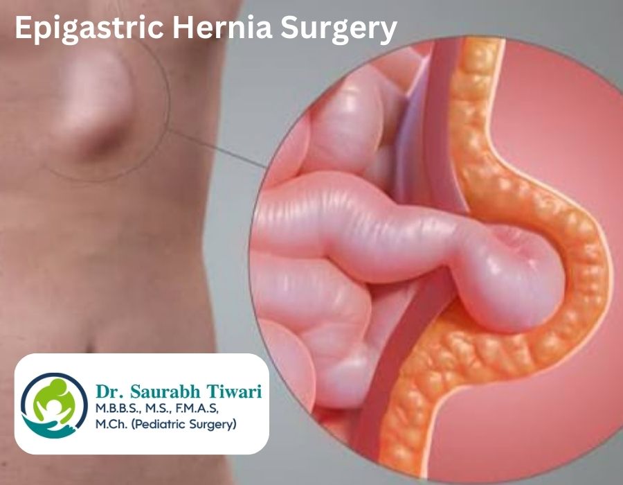 Is Epigastric Hernia Surgery a Major Procedure? | Dr. Saurabh Tiwari