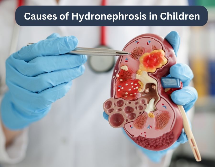 Main Causes of Hydronephrosis in Children | Dr. Saurabh Tiwari