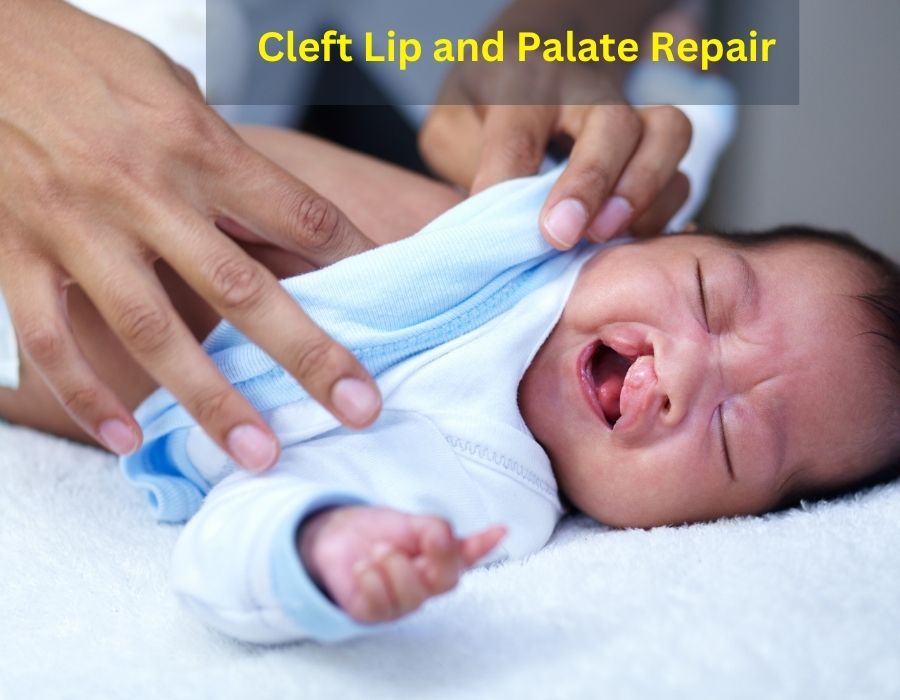 Cleft Lip and Palate Repair: A Comprehensive Guide for Parents