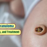 Umbilical granuloma: Symptoms, causes, and treatment